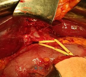 Visualizaci�n del hilio hep�tico