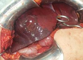 Demarcaci�n de l�nea de Cantlie posterior a ligadura de vena porta hep�tica derecha