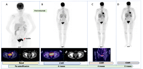 Respuesta o remisin metablica completa