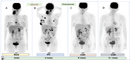 Respuesta completa a la inmunoterapia. Respuesta combinada. cncer escamo celular (cabeza y cuello)