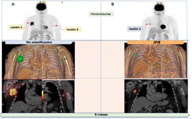 Respuesta parcial. (iPR) Melanoma tratado con pembrotizumad
