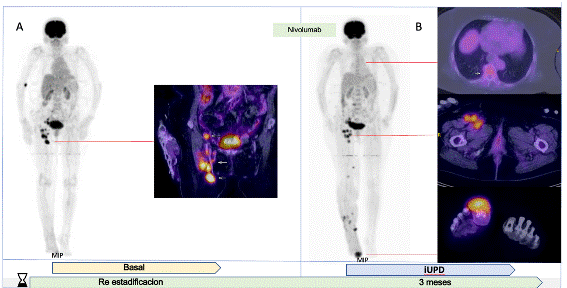 Enfermedad en progresin metablica no confirmada (iUPD).