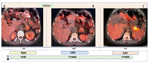 Enfermedad progresiva confirmada por el sistema inmunitario. (iCPD )