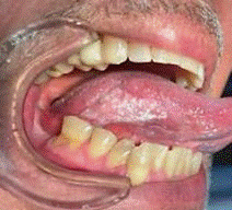 Carcinoma de c�lulas escamosas de lengua m�vil derecha.