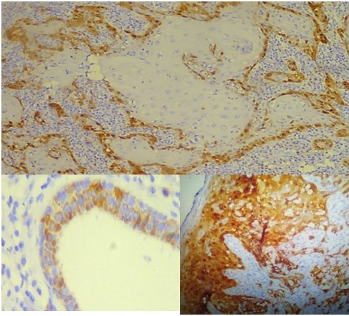 p16 nuclear y citoplasm�tico.