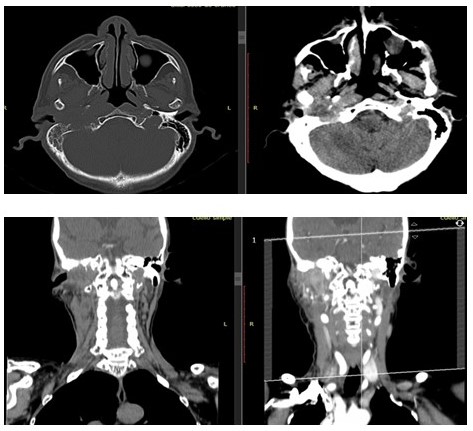 Tomograf�a computarizada control de cr�neo y cuello 18/03/2020, cortes axiales y coronales, con cambios posquir�rgicos a nivel de mastoides derecha, evidenci�ndose LOE adyacente a la misma y opacidad de las celdillas mastoideas derechas.