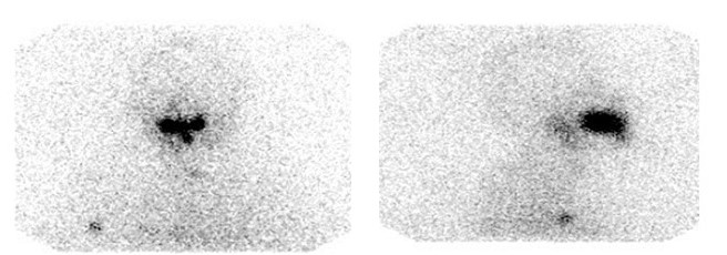 Rastreo corporal total (29/03/2021) que reporta presencia de escaso tejido iodo-captante en regi�n anterior del cuello residual, conducto auditivo externo derecho y ganglio axilar derecho