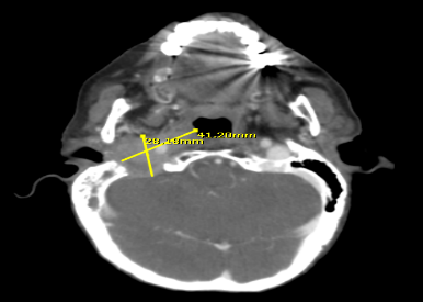 Tomograf�a de cuello simple (18/05/2021) de control. Lesi�n de ocupaci�n de espacio solida con densidad de partes blandas localizada en conducto auditivo medio derecho, con erosi�n �sea de la porci�n mastoidea del temporal ipsilateral, discretamente disrumpiendo la cortical del clivus. En fase arterial se evidencia captaci�n homog�nea, evidenciando extensi�n hasta porci�n adenoidea derecha y delimitando mejor la lesi�n midiendo aproximadamente 2,8 cm x 4,1cm, la lesi�n protruye asom�ndose hasta la transici�n del o�do externo. Existe velamiento de las celdillas mastoideas ipsilaterales a la lesi�n.