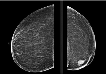 Proyecci�n c�falo caudal bilateral de la mamograf�a 2D.
