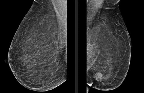 Proyecci�n medio lateral oblicua bilateral de la mamograf�a 2D.