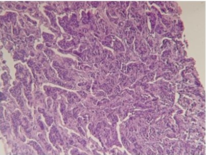 Infiltraci�n al tejido adiposo por carcinoma ductal moderadamente diferenciado (40X)