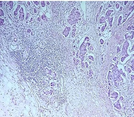 Biopsia definitiva de resecci�n local amplia que reporta carcinoma ductal infiltrante moderadamente diferenciado con �reas de patr�n micropapilar. (40 X)