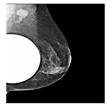  Mamograf�a medio lateral izquierda