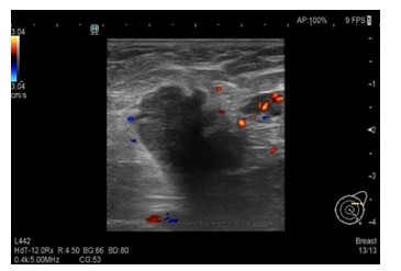 Ecograf�a axilar izquierda