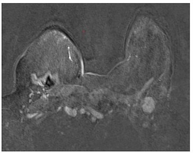 Resonancia magn�tica axila izquierda