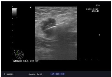 Biopsia ecoguiada aguja de corte