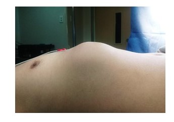 Paciente con aumento de volumen en tercio inferior de hemit�rax derecho, caracterizado por una masa no dolorosa en la pared costal anterolateral (interlineas blancas).