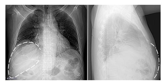 Radiograf�a PA y lateral derecha de t�rax: se aprecia una masa sobre la parrilla costal derecha, que no afecta a los arcos laterales de s�ptima, octava y novena costillas.