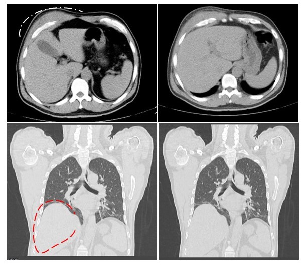 Tomograf�a computada de t�rax de alta resoluci�n. Donde se aprecia una masa de partes blandas en la cara anterolateral del hemit�rax derecho sin reacci�n peri�stica de los arcos costales subyacentes.