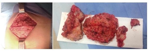 Toracotom�a antero lateral derecha a nivel del 9o espacio intercostal con resecci�n quir�rgica de la lesi�n tumoral en su totalidad muestra patol�gica macrosc�pica.