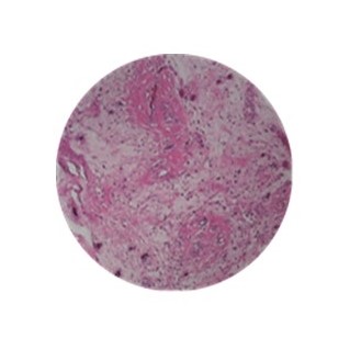 Microfotograf�a. Corte histol�gico se evidencia neoplasia mesenquimal  de c�lulas redondas y ovoides que proliferan de manera difusa con patr�n mixoide, carecen de atipia y mitosis, alternando con abundantes haces de col�gena hialina. La inmunohistoqu�mica mostr� vimentina positiva y prote�na S100 negativa.