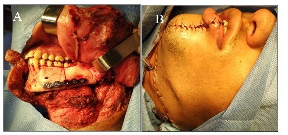 Colocacin de material de osteosntesis mandibular con placa de titanio 2,0 (a). sntesis final de piel (b).