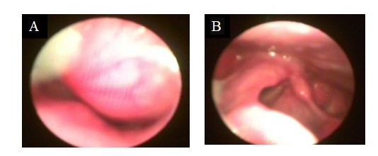 Nasofibrofaringolaringoscopia, visualizando lesin exoftica en orofaringe que protruye hacia nasofaringe (a). sin lesin orgnica en laringe (b).