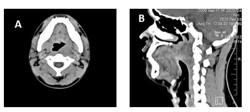 Corte axial de tomografa, donde se aprecia tumor en pared lateral izquierda de orofaringe (a), corte sagital, donde se aprecia tumor en orofaringe solido (b).