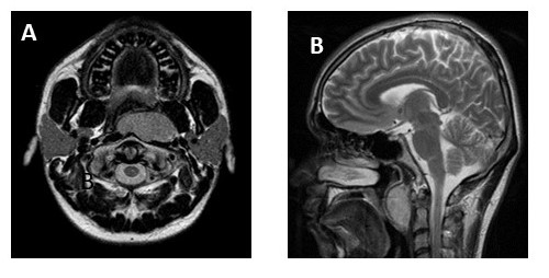 Corte axial de resonancia magntica, con tumor en orofaringe y infiltracin de fascia prevertebral y msculos prevertebrales, sin infiltrar cuerpo vertebral (a), corte sagital (b).