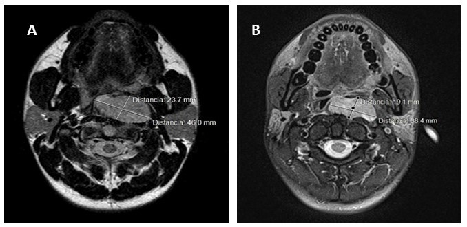 Corte axial de RM pre quimioterapia, con tumor en orofaringe de 23,7 mm x 46,0 mm, que infiltra fascia prevertebral y msculos prevertebrales (a). Corte axial de R posterior a quimioterapia, con reduccin de tamao de lesin tumoral, de 19,1 mm x 38,4 mm (b).