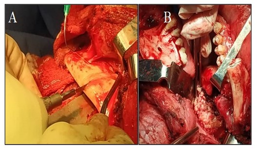 Mandibulotoma lateral izquierda (a). Swing mandibular con visualizacin de orofaringe (b).