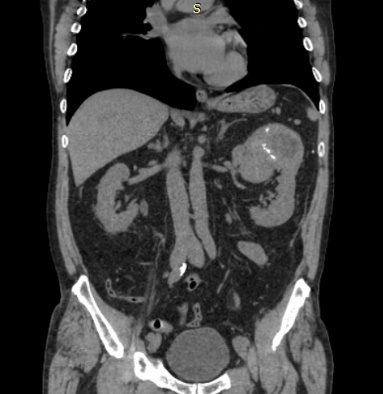 Urotomografa con contraste en cortes coronales donde se evidencia LOE en polo superior del rin izquierdo.