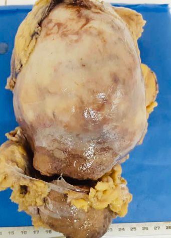 Pieza de nefrectoma izquierda.