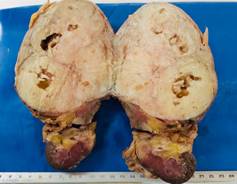 Pieza de nefrectoma en la que se identifica un ndulo firme bien delimitado que mide 10x9x8 cm. Al corte se observa un parnquima blanquecino de consistencia elstica con aspecto fascicular.