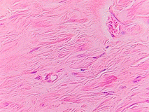 En el leiomioma destaca la presencia de clulas fusiformes dispuestas en haces separados en el seno de un estroma laxo hialinizado (crecimiento fascicular). Hay ausencia de mitosis y otros signos de malignidad. Coloracin H&E 200x