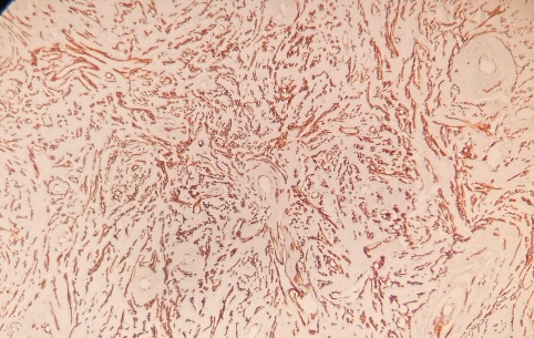 Inmunorreaccin a Actina del Msculo Liso (AML) 100x. destaca la presencia de fibras y fascculos musculares e inmunomarcaje de fuerte intensidad en la pared vascular.