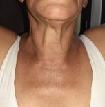 Examen fsico de regin cervical anterior.