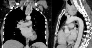 TC de cuello y trax evidenciando LOE en mediastino anterior en relacin a glndula tiroides y colindando con los grandes vasos torcicos.