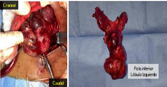 Glndula tiroides in situ y pieza quirrgica ex vivo