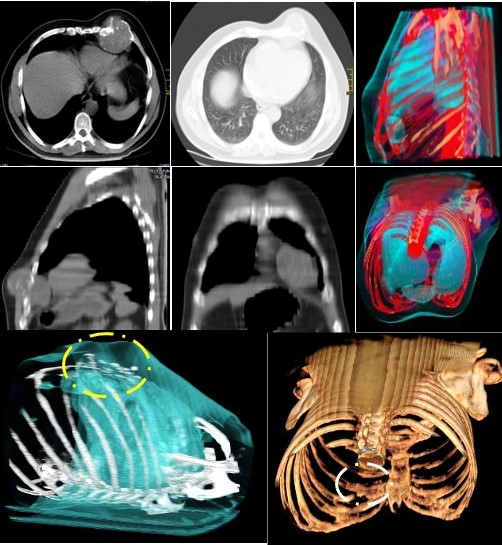 TC t�rax que muestra una lesi�n ovalada (c�rculo) con destrucci�n �sea l�tica de la cortical de la VII (110 mm x 100 mm x 59 mm de tama�o). Los m�rgenes estaban mal delineados con alguna matriz osificante sin evidencia de extensi�n al tejido blando adyacente. Cortes axial, coronal y sagital. Reconstrucci�n 3D. TC.
