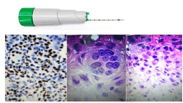 Dispositivo autom�tico no reutilizable para biopsia. (BARD-MONOPTY�).14 GAUGE Corte histol�gico se evidencia neoplasia hamartoma vs. lipoma pulmonar, no se descart� malignidad. Microfotograf�a Corte histol�gico se evidencia lesi�n compuesta por condroblasto redondos o poli�dricos, con n�cleos ovalados, algunos hiperlobulado con surcos, con citoplasma eosinof�lico sin figuras mit�ticas con elementos fusiforme y degeneraci�n mixoide