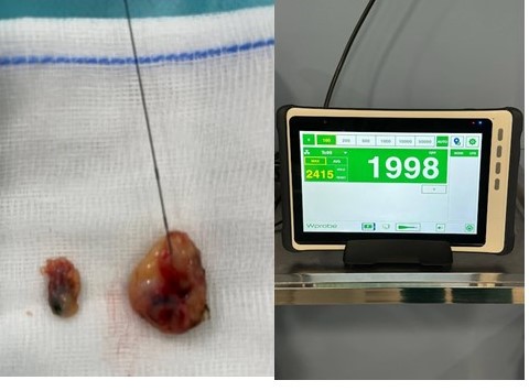 TAD. Ganglio con arpn, azul de metileno y caliente (99mTc).