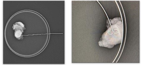 RX ganglio: adenopata axilar con clip y arpn.