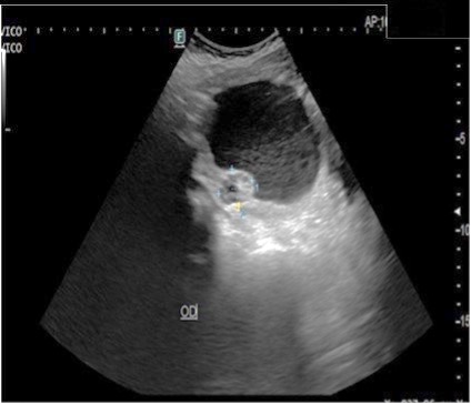 Ultrasonido abdomino-plvico.