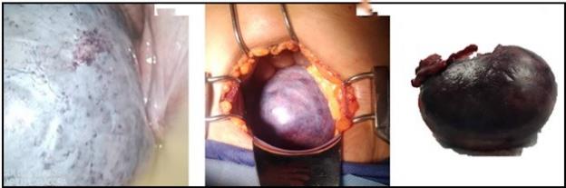 Figura 2. Laparoscopia exploradora. Figura 3. Laparotoma mediana infraumbilical. Figura 4. Ooforosalpingectoma derecha.