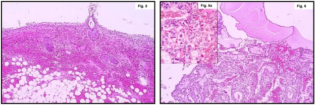 Figura 5. MCT   Figura 6, 6a Carcinoma papilar originado de tejido tiroideo