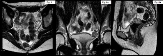 RMN de abdomen y pelvis con gadolinio.