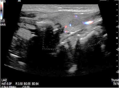 Ultrasonido tiroideo.