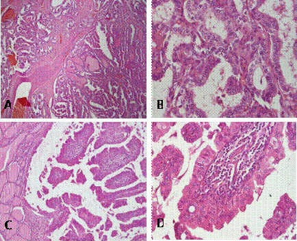 Patolog�a quir�rgica caso 1. (A) Carcinoma papilar variante cl�sica. Tinci�n H-E, 10X. (B) Cambios nucleares propios de carcinoma papilar. (C) Carcinoma papilar Warthin Like. Ejes papilares expandidos por infiltrado inflamatorio linfoplasmocitario. Tinci�n H-E, 10X. (D) Eje papilar revestido por c�lulas neopl�sicas de aspecto oncoc�tico, exhibiendo abundante citoplasma eosin�filo granular y n�cleos centrales con cambios de carcinoma papilar. Tinci�n H-E, 40X.