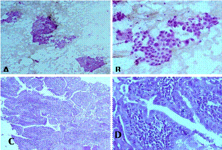 Citolog�a y patolog�a quir�rgica. Caso 2. (A). Citolog�a: arquitectura arboriforme propia del carcinoma papilar. Tinci�n H-E, 10X. (B). Citolog�a. Discohesividad, alteraci�n de la polaridad, anisocariosis, hipercromasia y pseudoinclusiones intranucleares. Tinci�n H-E, 40X. (C). Ejes papilares con presencia de infiltrado inflamatorio linfoplasmocitario expandiendo el tallo papilar. Tinci�n H-E, 10X. (D). Epitelio de revestimiento papilar con cambios oncoc�ticos y n�cleos de carcinoma papilar. Tinci�n H-E, 40X.